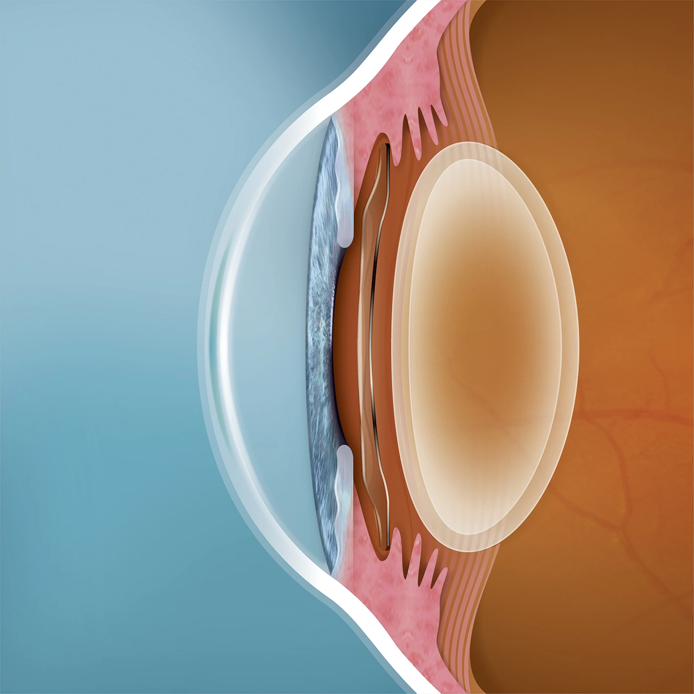 6_Linse im Auge_nach OP